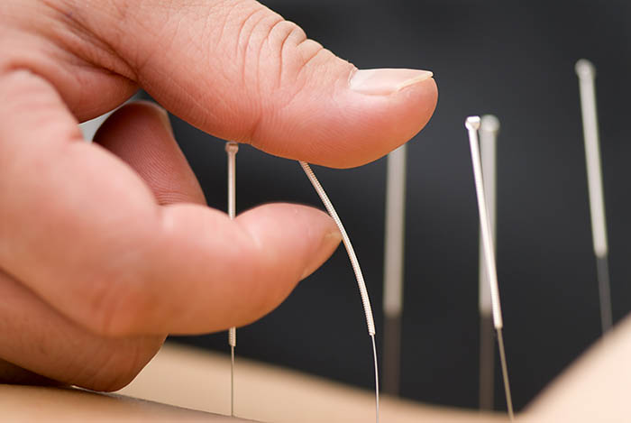 acupuncture needles sorts