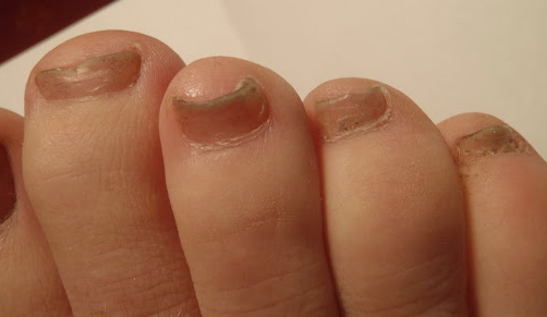 Toenail fungal infection