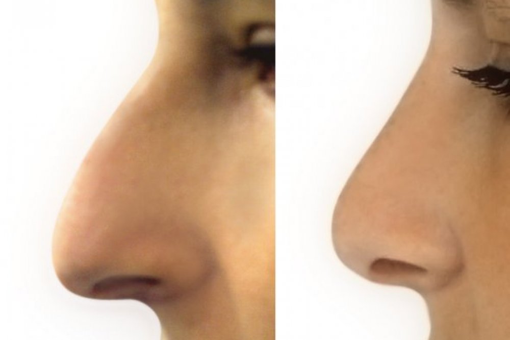 Rhinoplastik