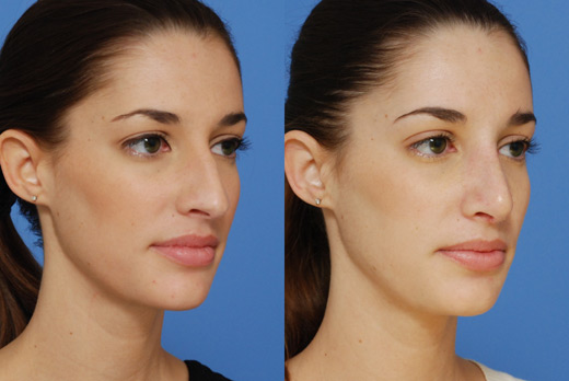 Rhinoplasty La Jolla