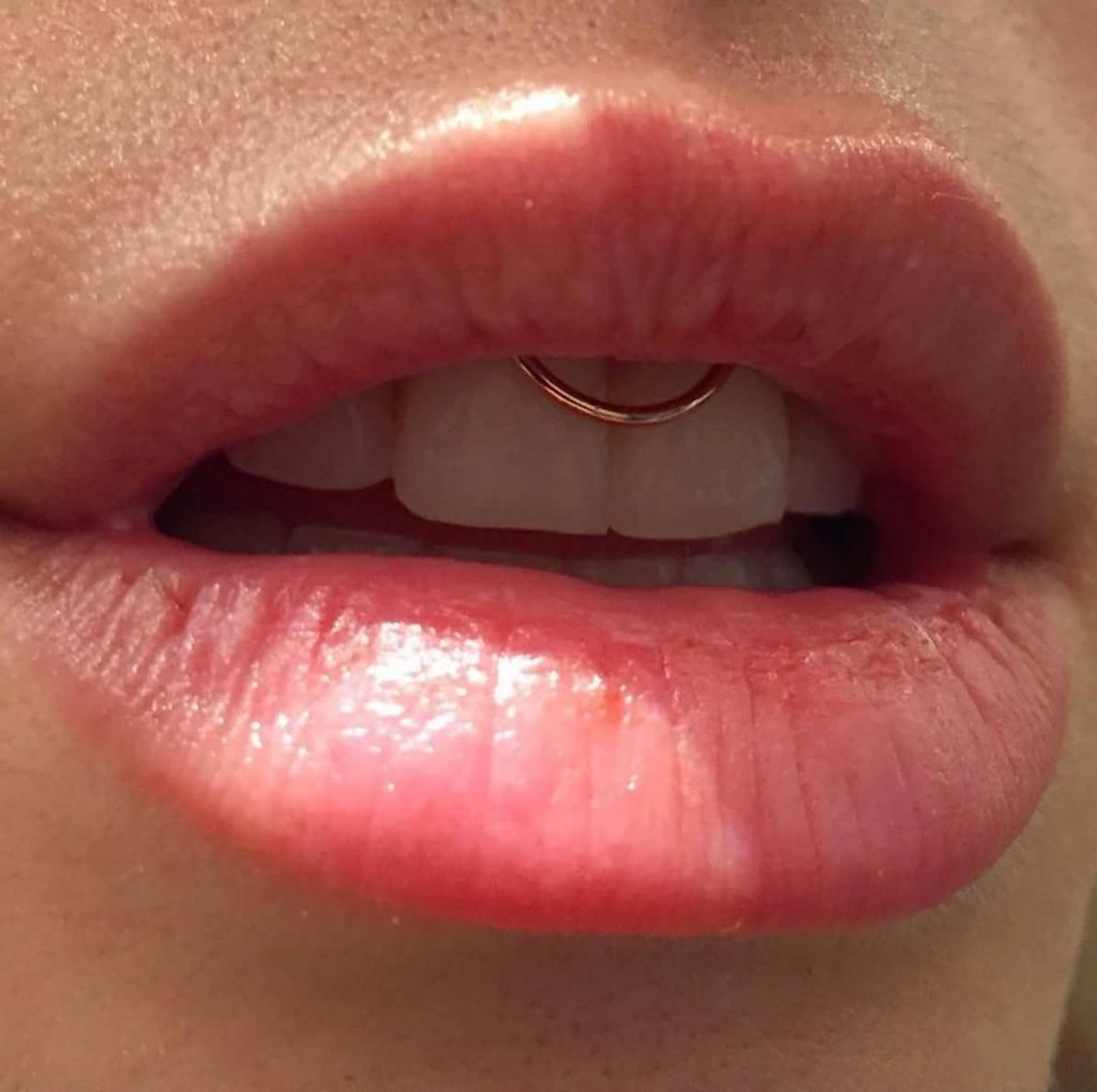 smiley piercing