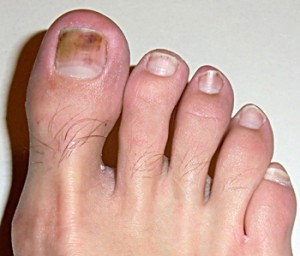 nail fungus