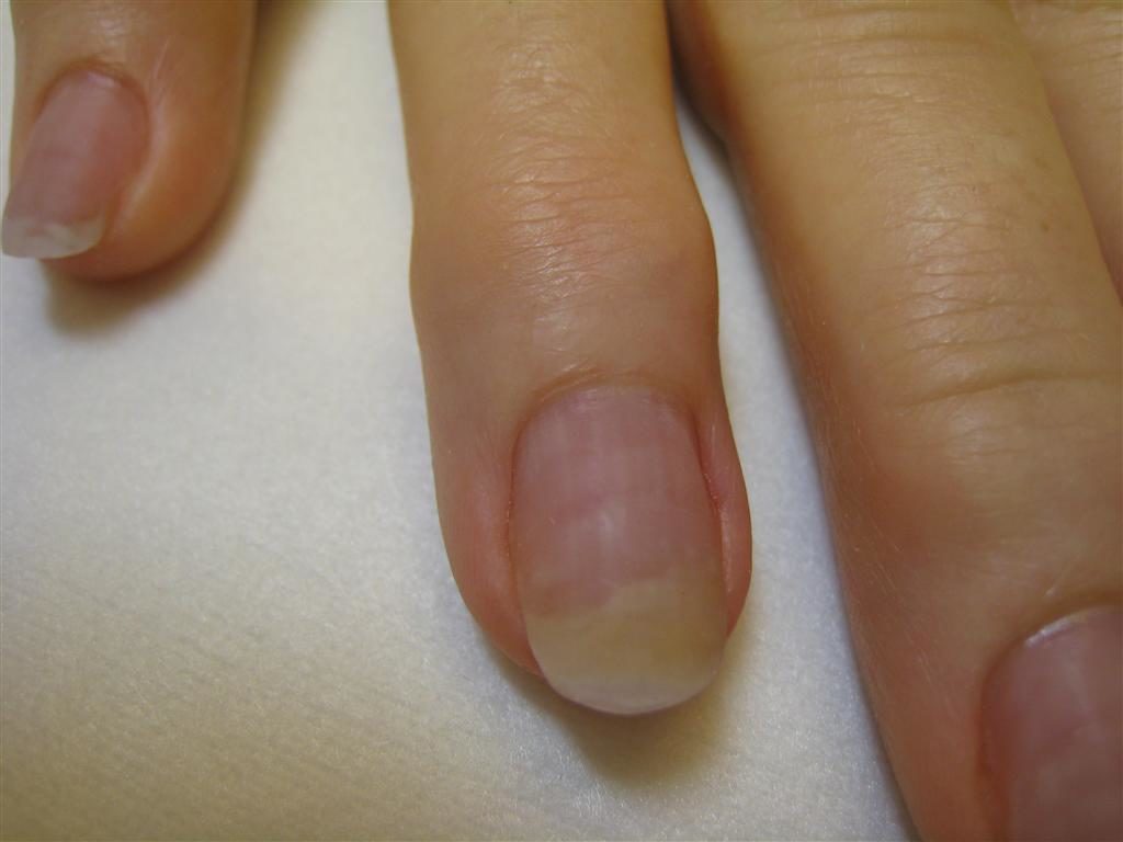 Nail fungal infections